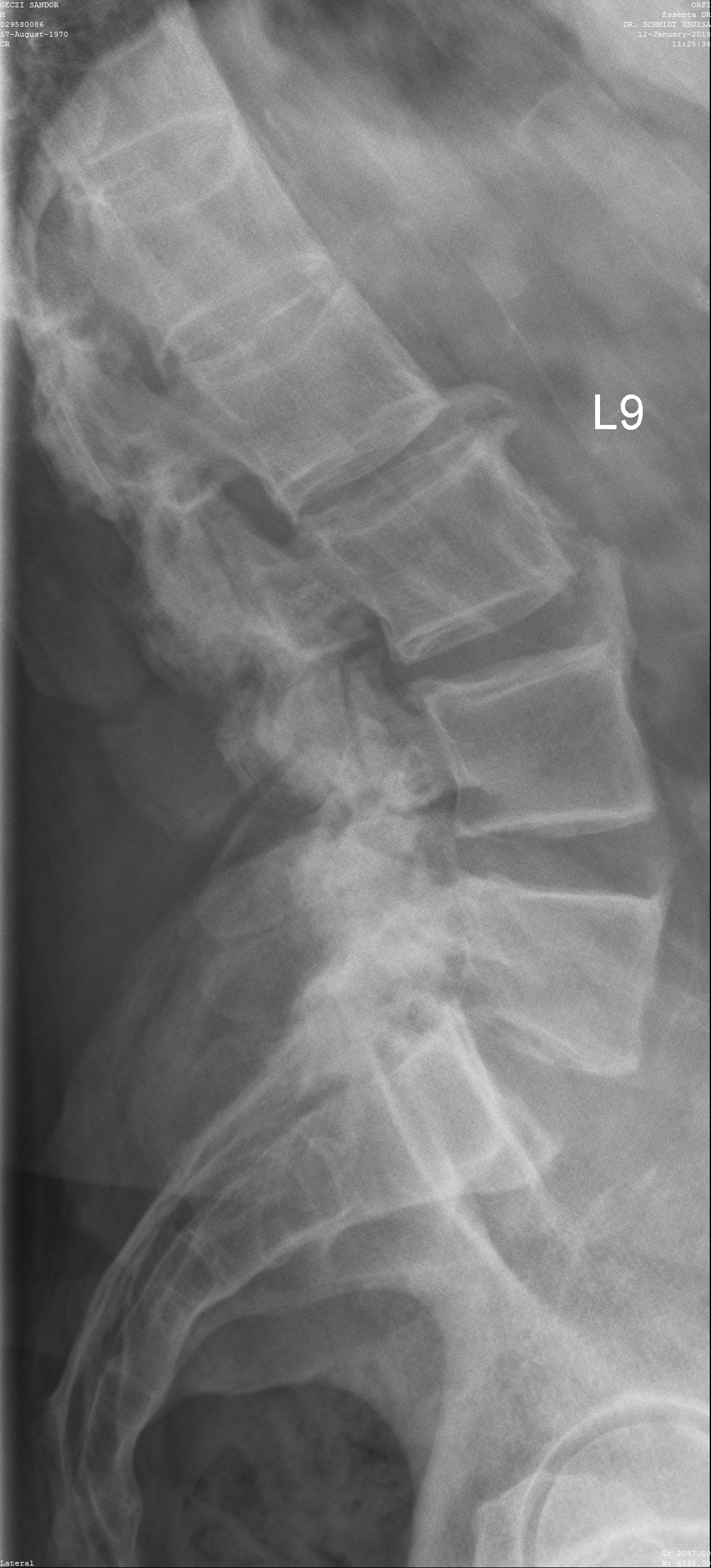 erős hátfájás a bordák alatt kezdeti arthrosis