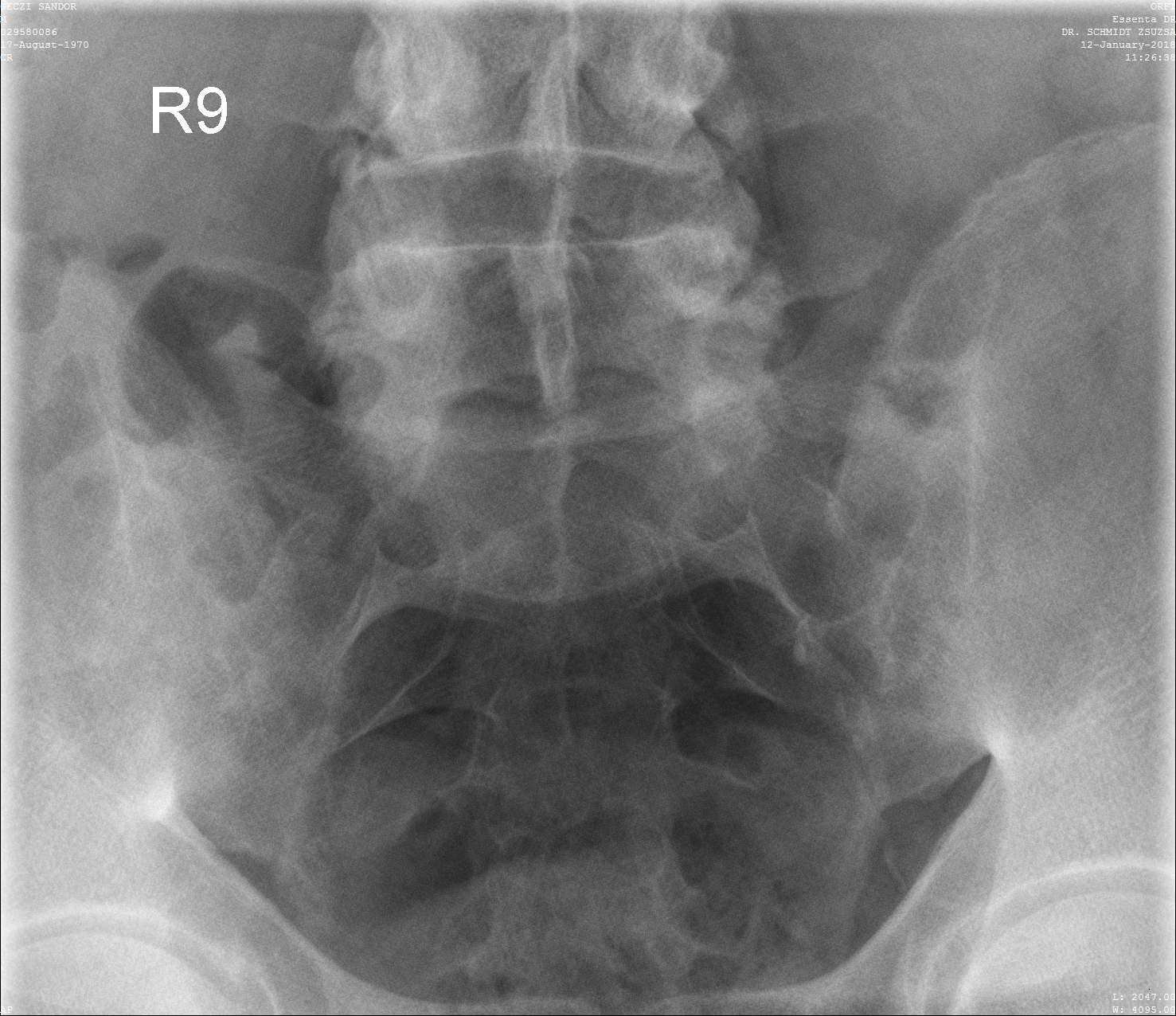 gerincgyulladás kezelése alsó hátfájás a bal oldalon