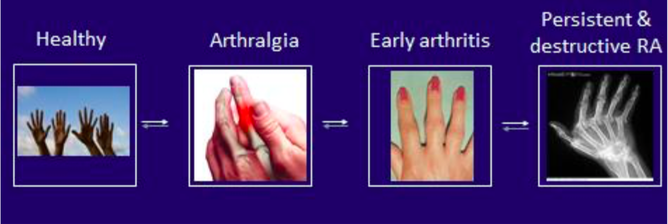 rheumatoid arthritis kialakulása